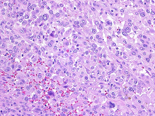 Anti-angiogenic and anti-metastatic effects of PEDF overexpression in anaplastic thyroid cancer cells: A preliminary in vitro study